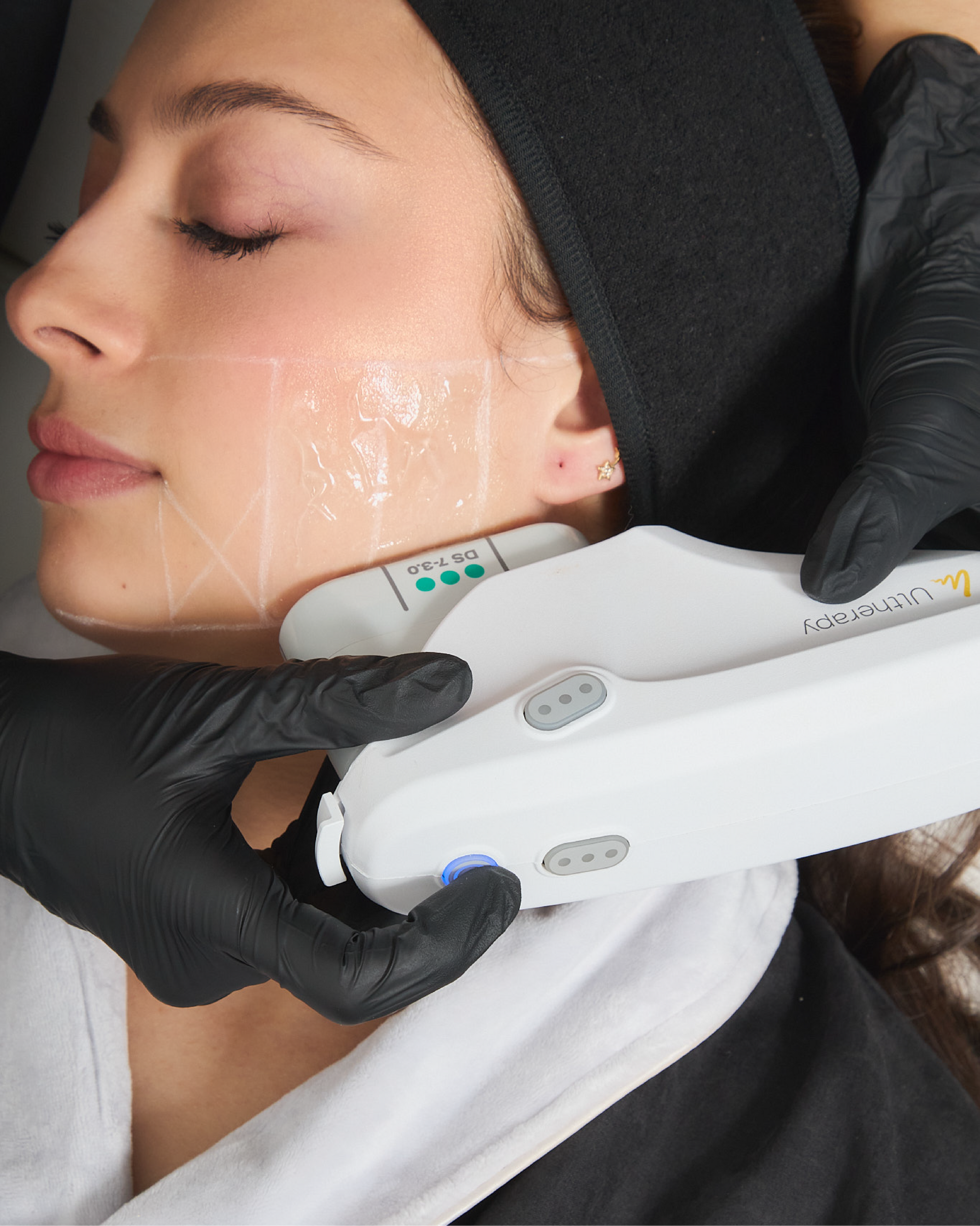 ULTHERAPY PRIME